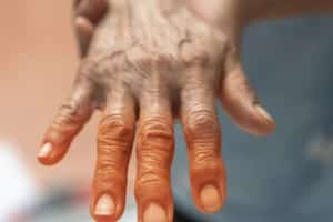 What is Peripheral Neuropathy? | All American Healthcare