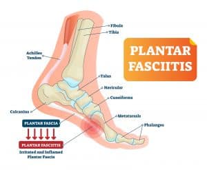As summer activities go into high-gear, watch out for Plantar Fasciitis
