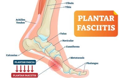 As summer activities go into high-gear, watch out for Plantar Fasciitis